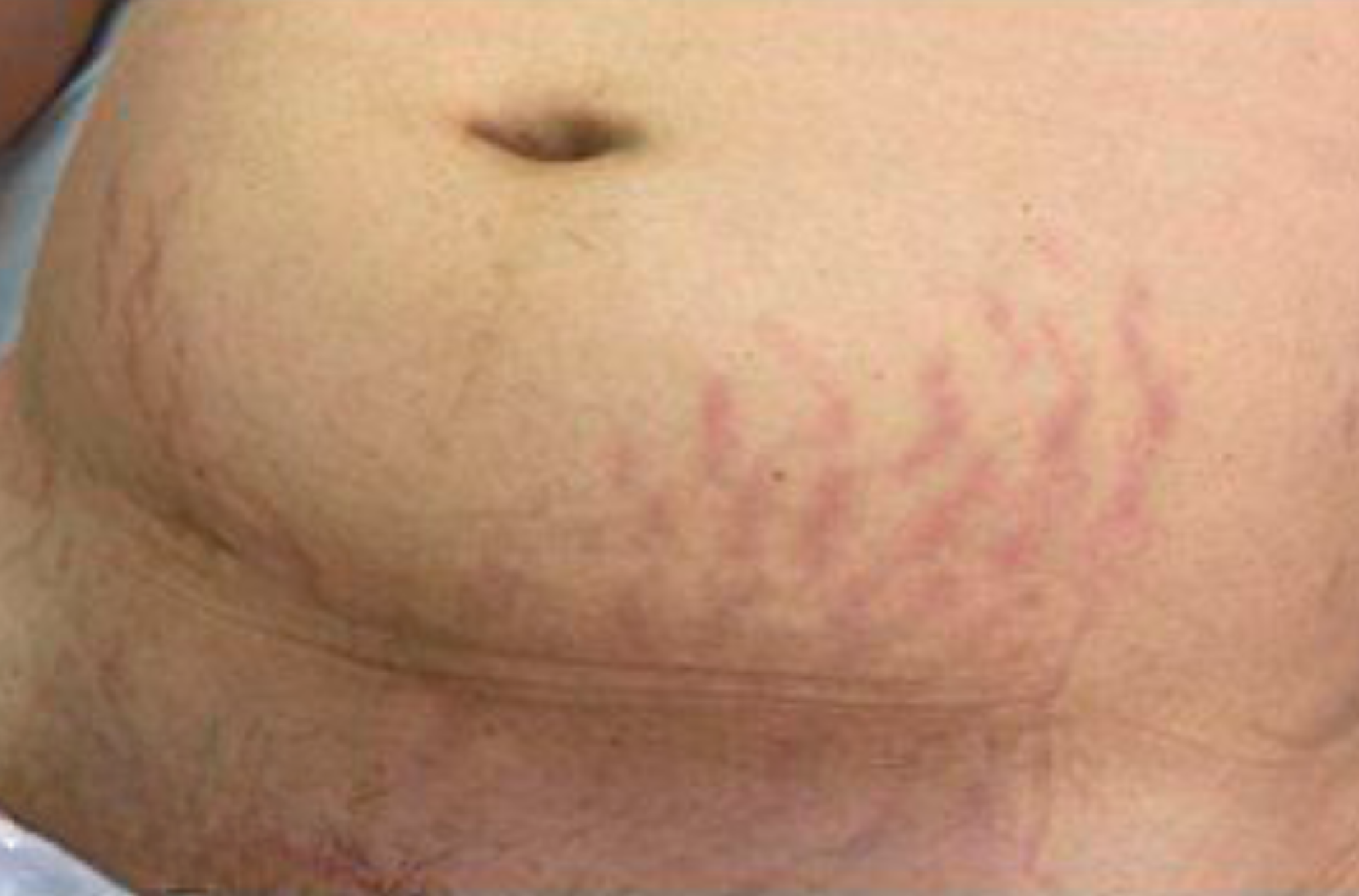 Antes-Estria-Barriga-2.png