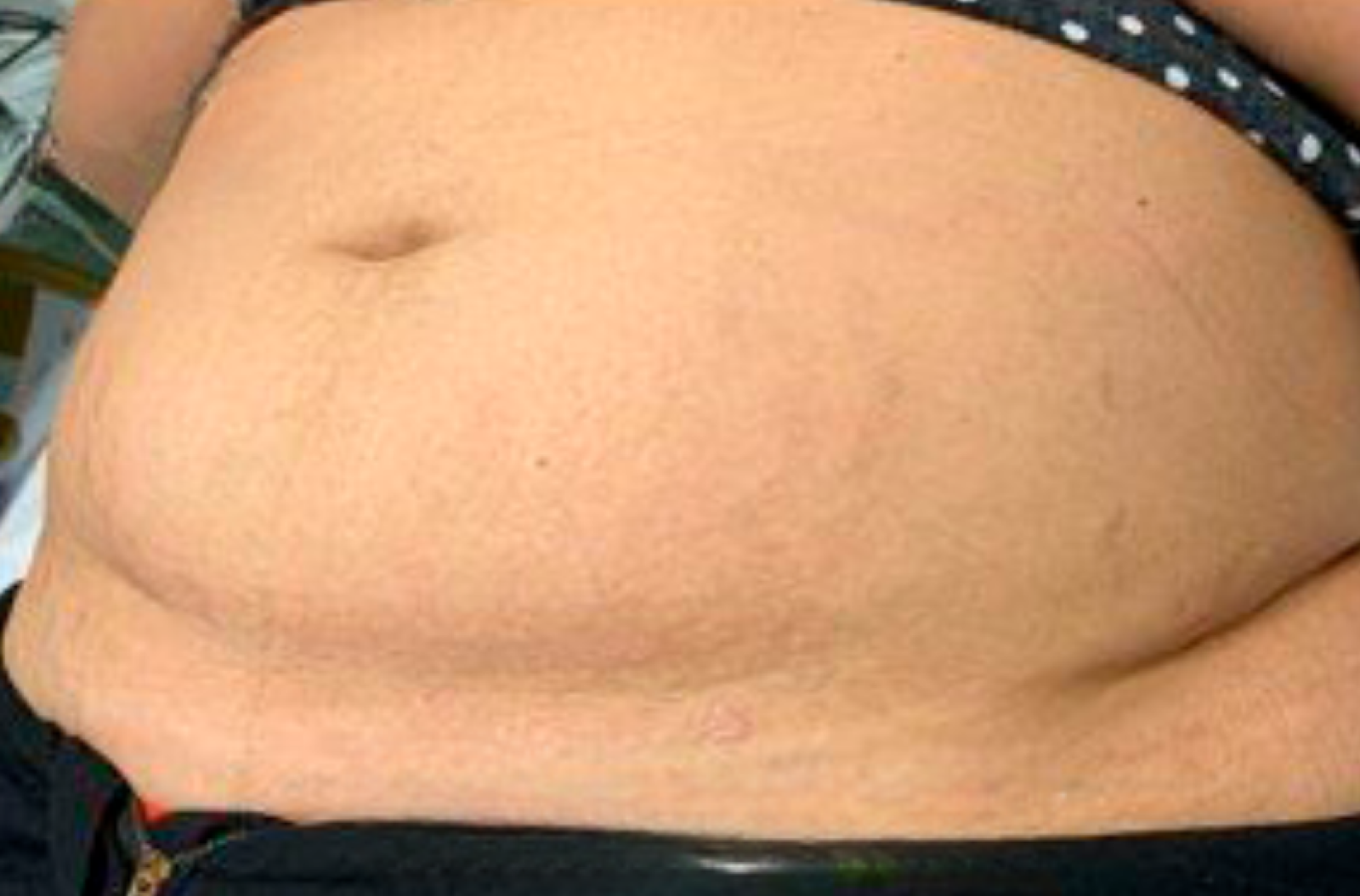 Depois-Estria-Barriga.png